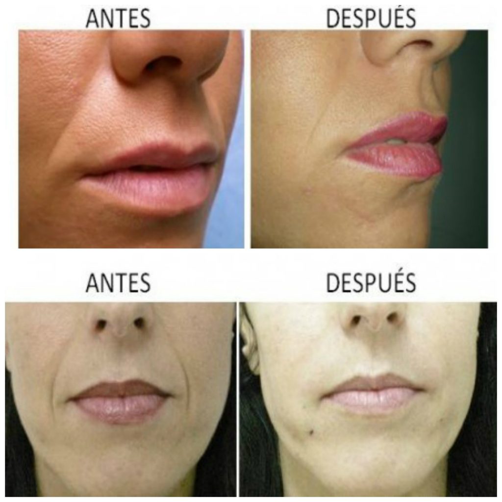 Clínica de implantes estéticos en Córdoba. Técnica de liposowing.