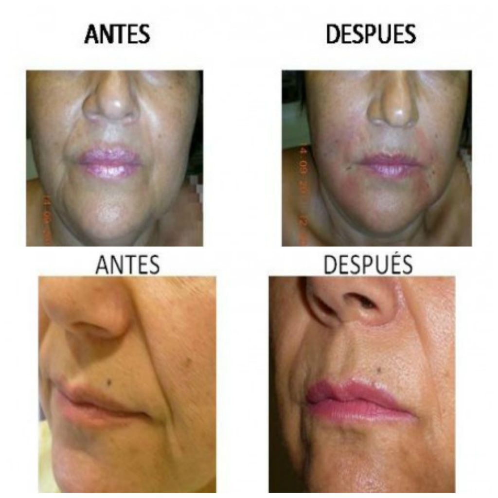 Técnica de liposowing en clínica de implantes estéticos en Córdoba Medicina Estética Carmen Traseira.