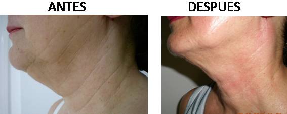 Efectos de la Radiofrecuencia Accent Facial