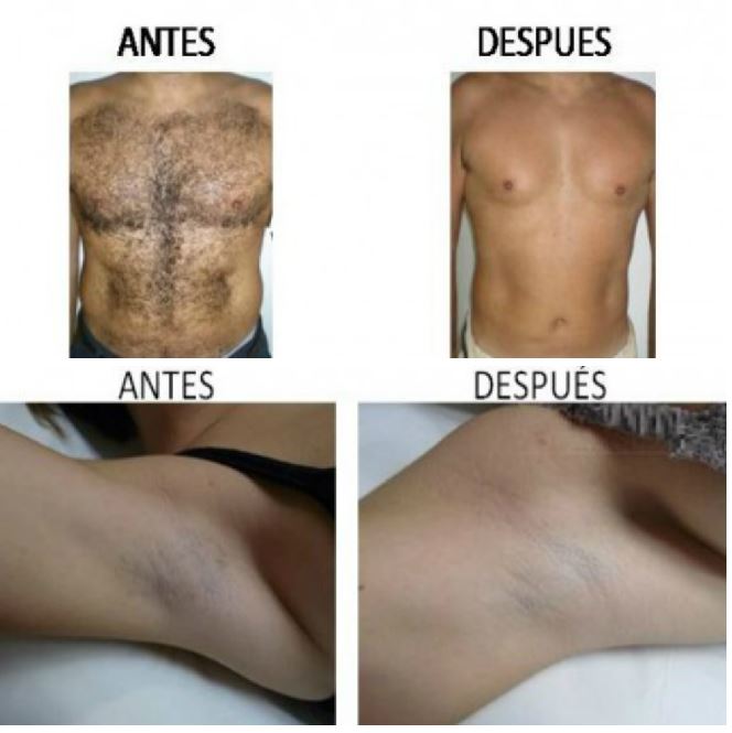 Resultados fotodepilación antes-después.