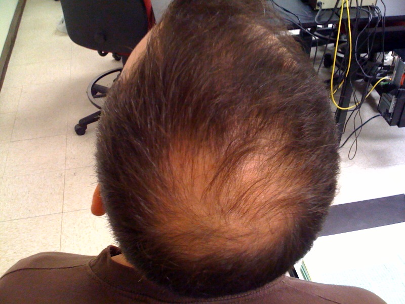 Tratamiento de alopecia con PRP