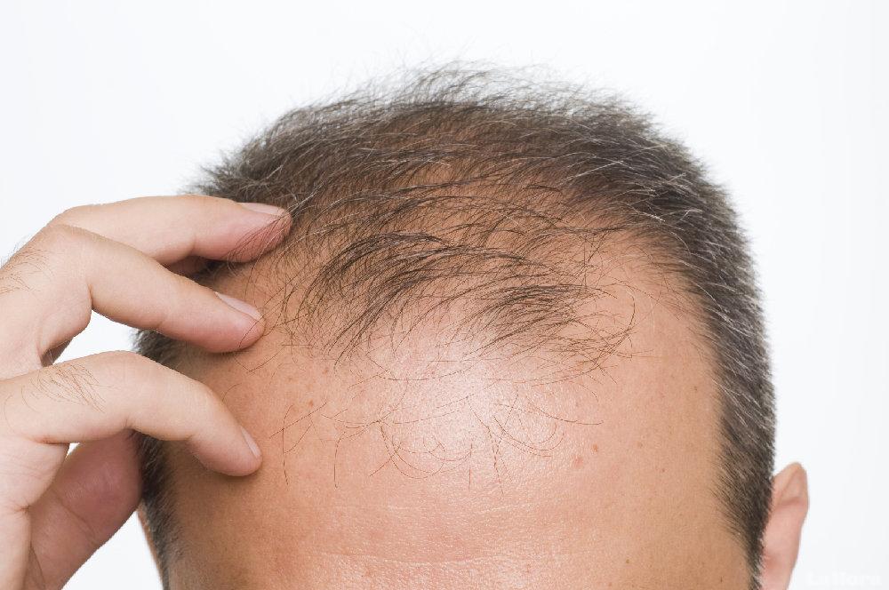 Eliminar alopecia en Córdoba