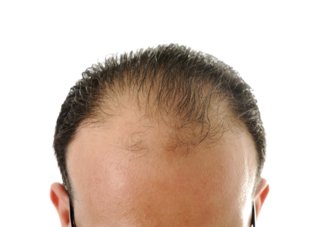 Eliminar alopecia en Córdoba