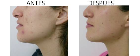 Antes y después del tratamiento del acné
