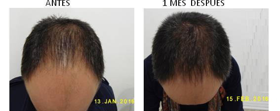 Alopecia_antes-después_01