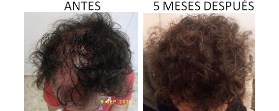 Alopecia_antes-después_02
