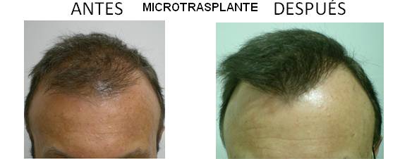 Alopecia_antes-después_03