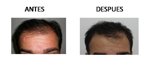 Alopecia_antes-después_04