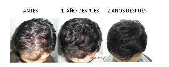 Alopecia_antes-después_05