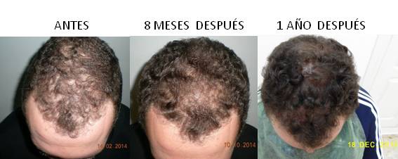 Alopecia_antes-después_06