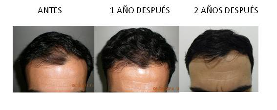 Alopecia_antes-después_07