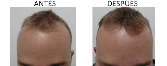 Alopecia_antes-después_10