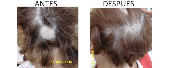 Alopecia_antes-después_11