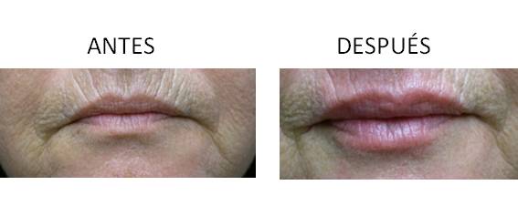 Antes y después del aumento de labios.