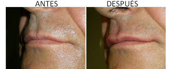 Antes y después del aumento de labios.