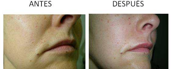 Antes y después de realizar los implantes faciales
