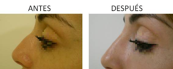 Antes y después de realizar los implantes faciales
