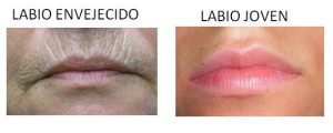 Labio envejecido y labio joven