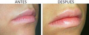 Aumento de labios