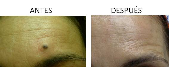 Antes y después del tratamiento para eliminar lunares y verrugas en Córdoba.