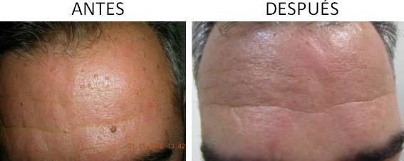 Antes y después del tratamiento para eliminar lunares y verrugas en Córdoba.