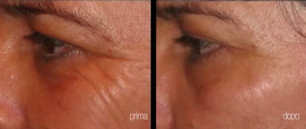 Antes y después del laser resurfacing facial