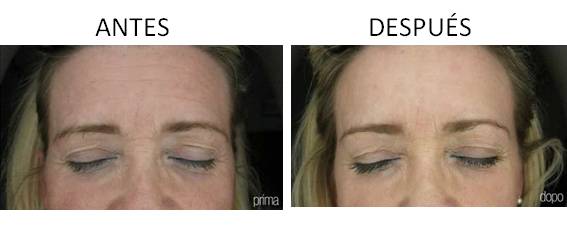 Antes y después del laser resurfacing facial