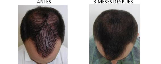 Antes y después del aumento con plasma con Factor de Crecimiento Epidérmico
