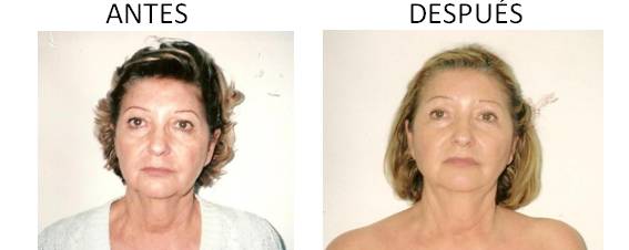Antes y después de la radiofrecuencia facial AccentXL