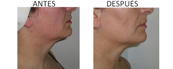Antes y después de la radiofrecuencia facial AccentXL