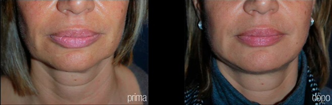 Antes y después de la remodelación de óvalo facial y eliminación de papada con láser