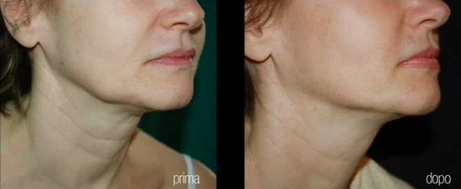 Antes y después de la remodelación de óvalo facial y eliminación de papada con láser